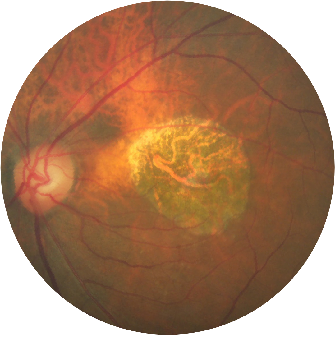 geographic-atrophy-disease-progression-diagnosis-apellis